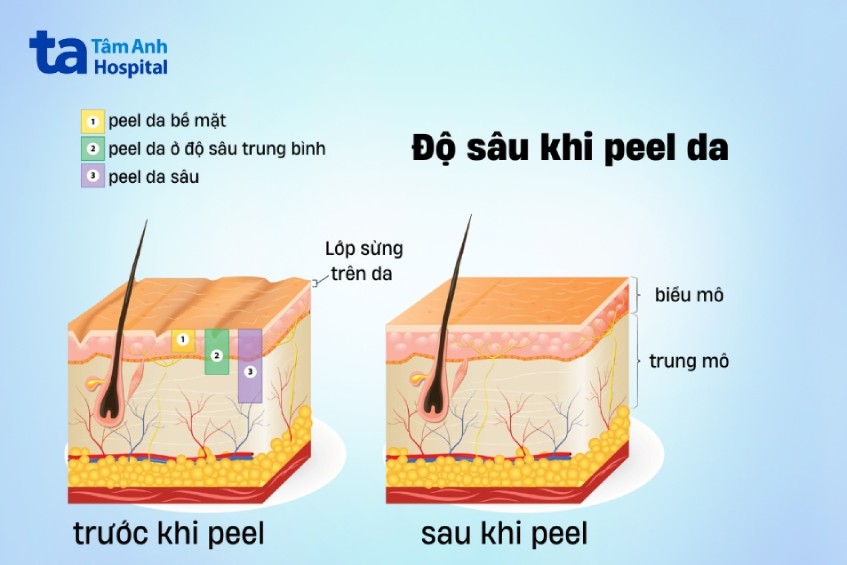 khi nào nên peel da body