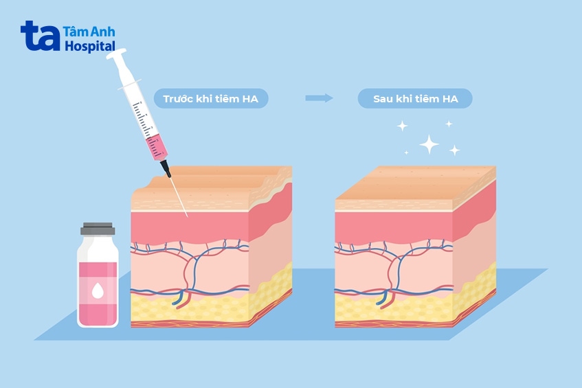 khi nào thì nên lựa chọn tiêm ha
