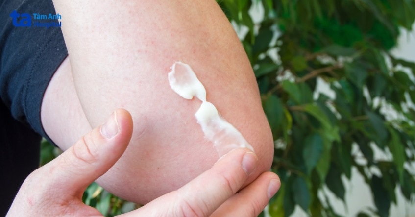 không tự ý tìm mua thuốc bôi kiến ba khoang