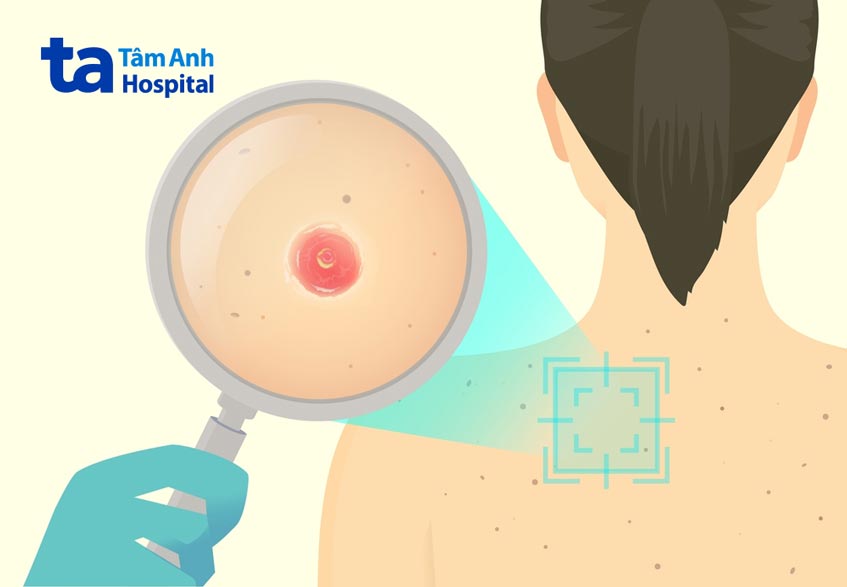 lymphomatoid papulosis thường giống mụn nhọt lớn