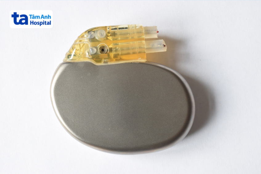 Máy tạo nhịp tim không dây được sử dụng phổ biến trong điều trị bệnh lý tim mạch