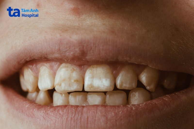 Nguyên nhân khiến men răng yếu