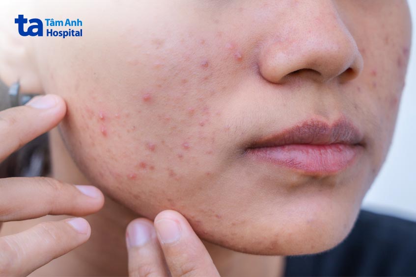 mụn trứng cá là dấu hiệu tăng prolactin máu