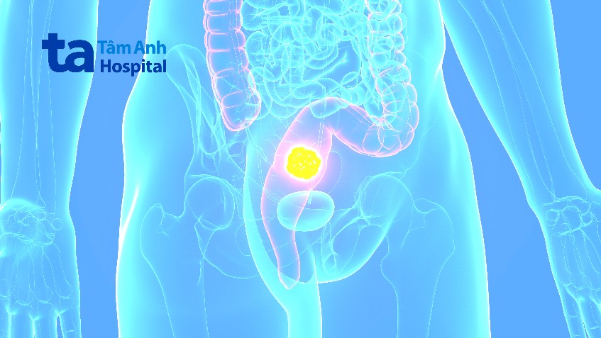 nên kiểm tra sức khỏe ung thư trực tràng