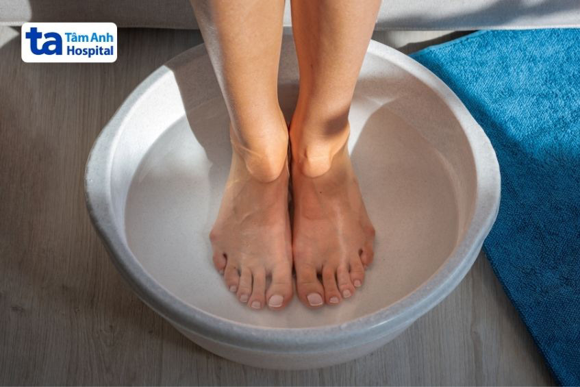 Ngân chân trị suy giãn tĩnh mạch tại nhà hiệu quả