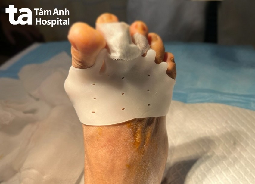 Người bệnh bị biến dạng bàn chân