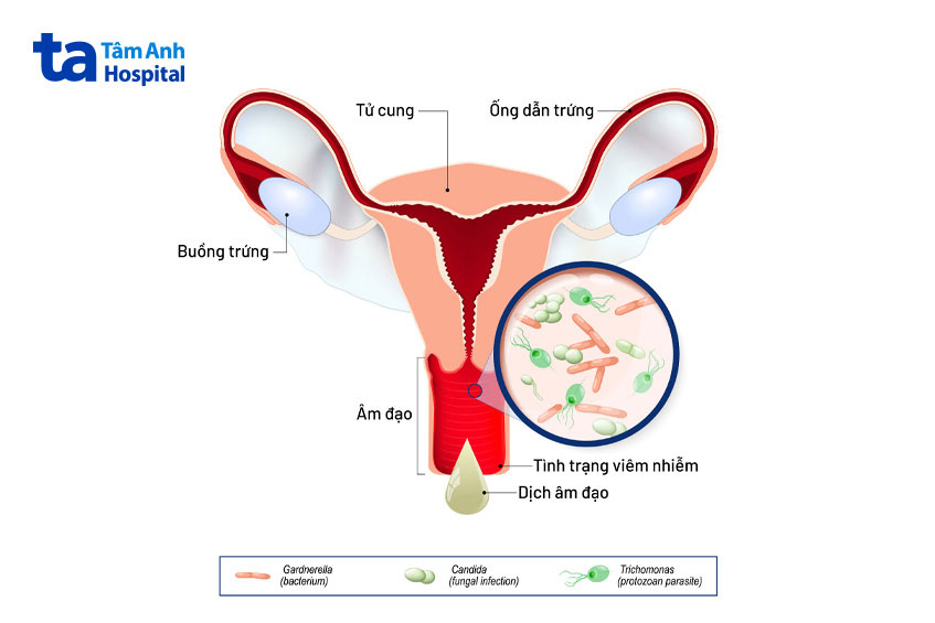 nhiều tác nhân gây bệnh viêm âm đạo