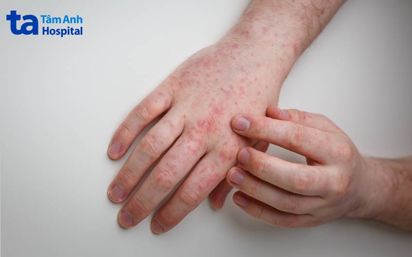phát ban có thể là triệu chứng sớm của tình trạng ghép chống lại vật chủ