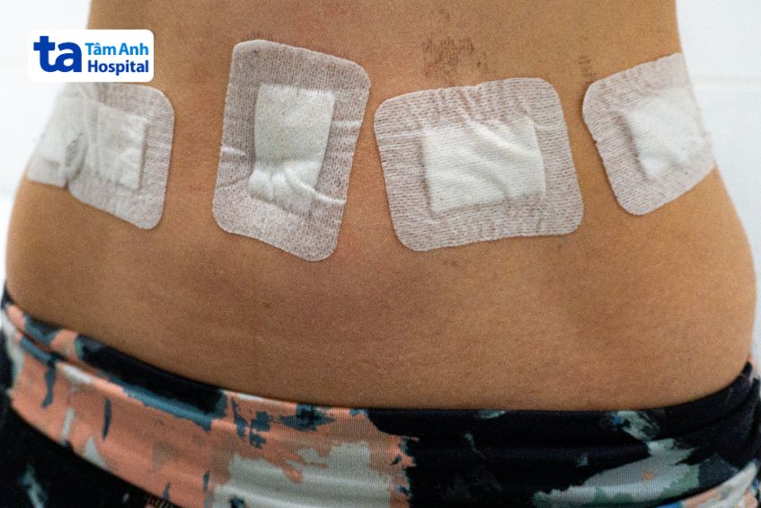 phẫu thuật điều trị co thắt tâm vị