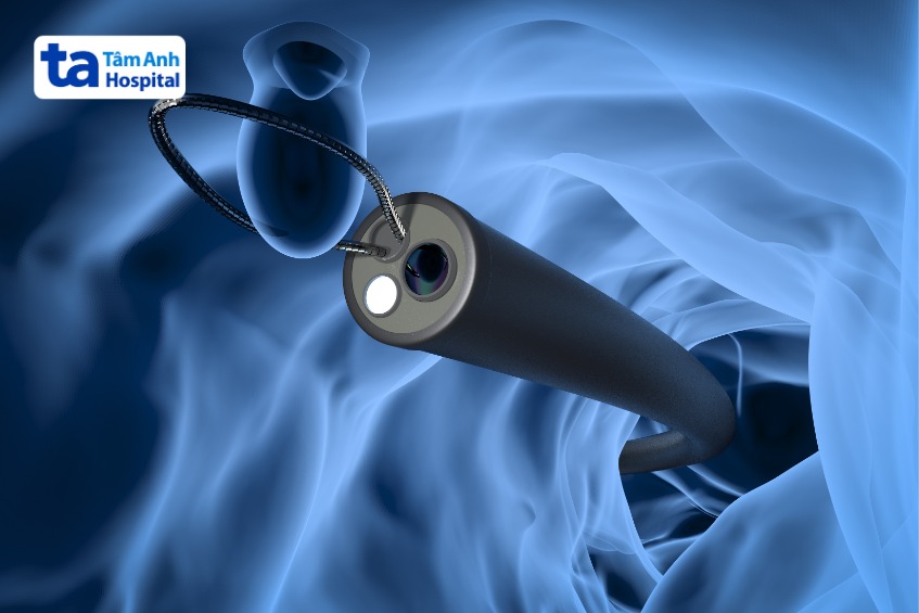 phẫu thuật nội soi cắt u thực quản