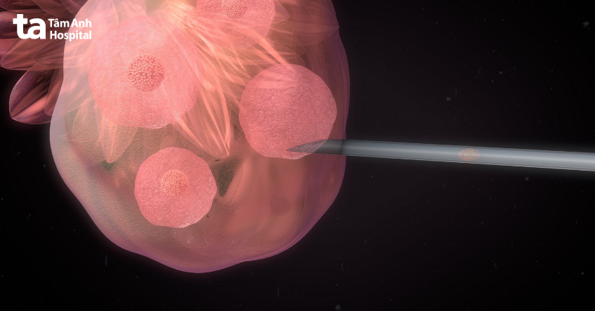 Quá trình chọc hút noãn tiềm ẩn nguy cơ nhiễm trùng, tổn thương cơ quan vùng chậu