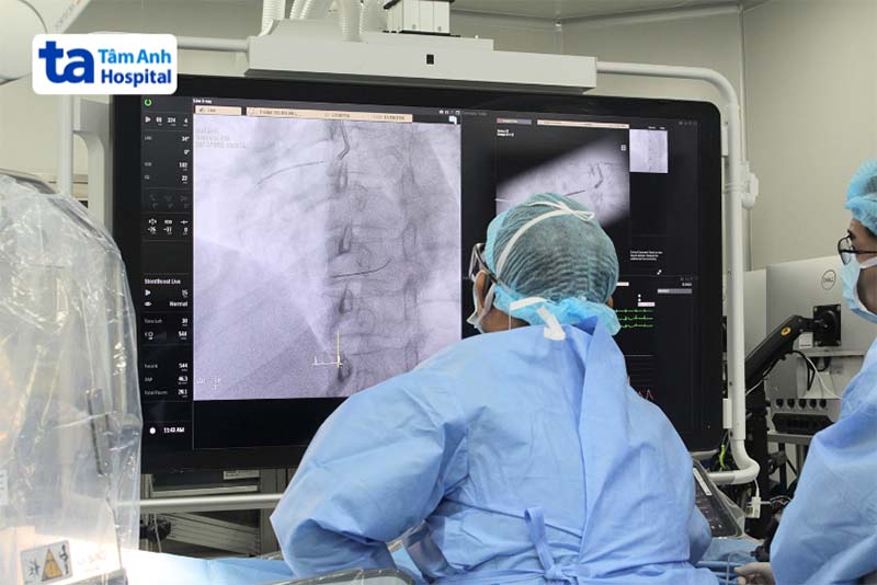 siêu âm nội mạch ivus