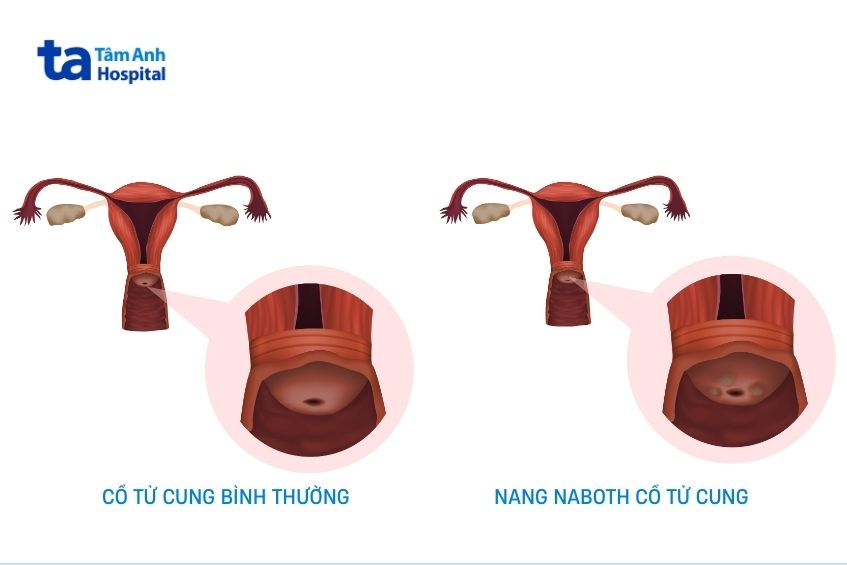 so sánh cổ tử cung bình thường và nang naboth