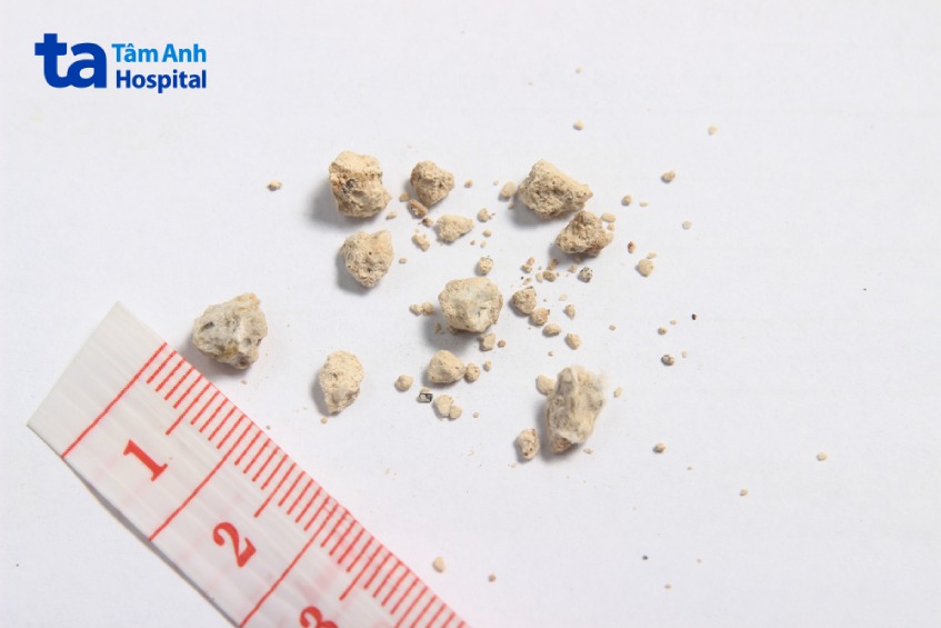 sỏi nhỏ ở trong thận