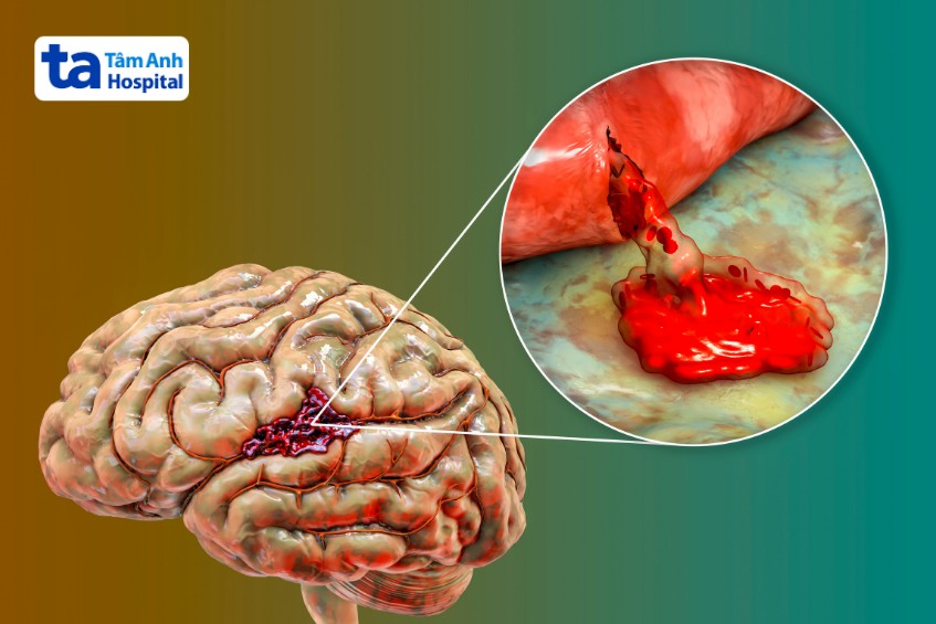 sốt buồn nôn đau đầu do xuất huyết não