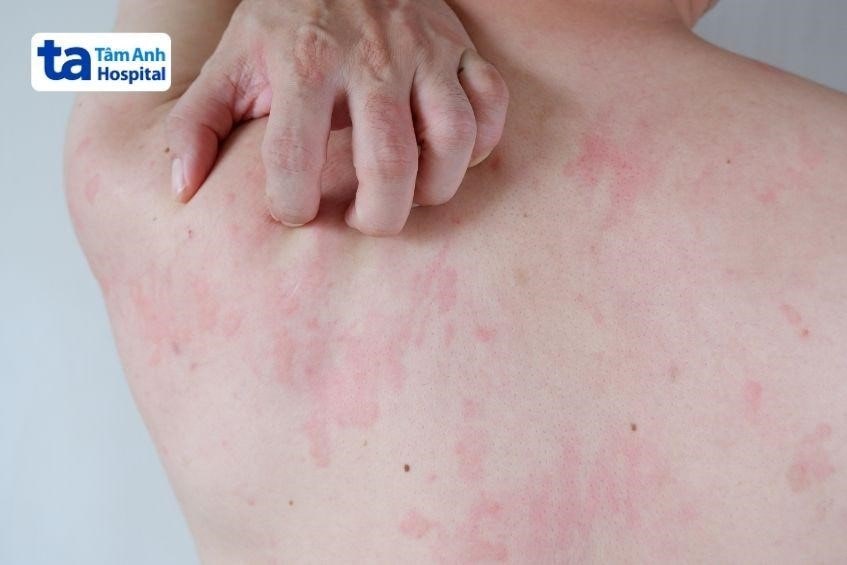 Tác dụng phụ của Lyrica 75mg