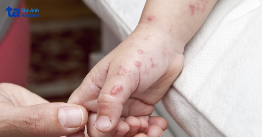 tác hại không lườn của kiến ba khoang