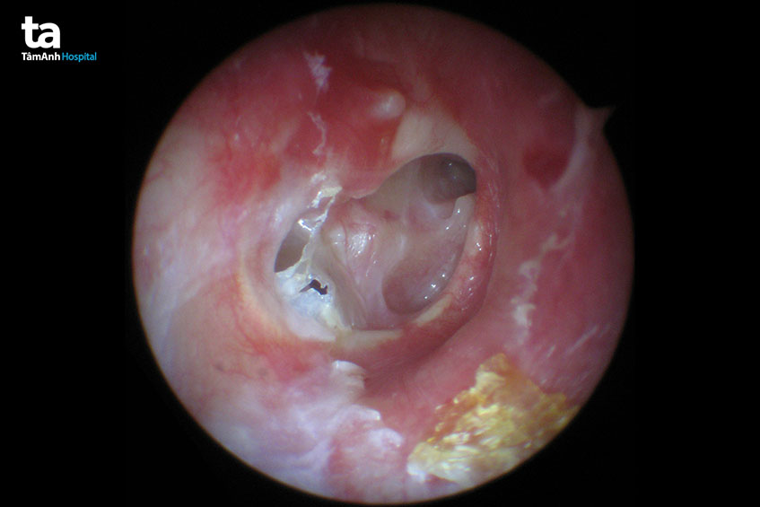tai bị thủng màng nhĩ có chữa được không