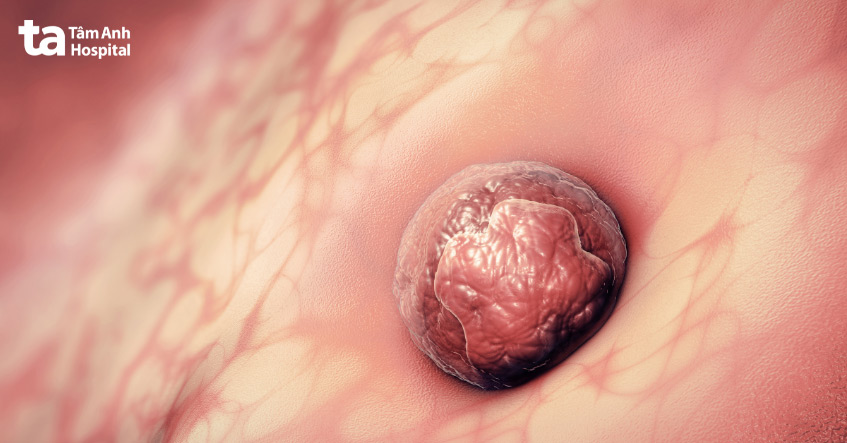 Tại sao chuyển phôi nhiều lần thất bại là nỗi ám ảnh đối với bệnh nhân nhiều lần không đậu thai