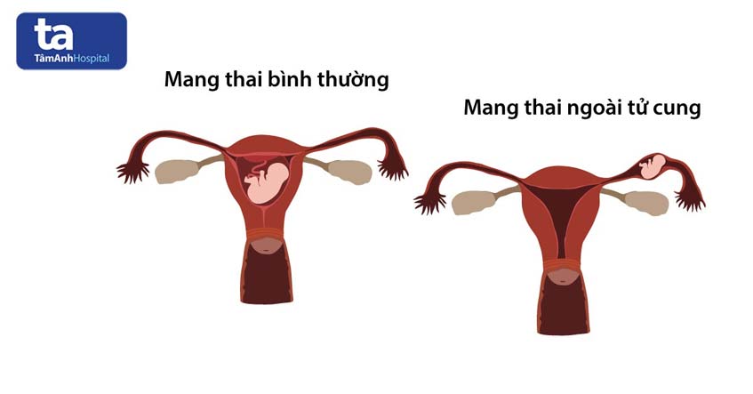 thai ngoài tử cung là một trong những nguyên nhân làm máu báo thai ra nhiều