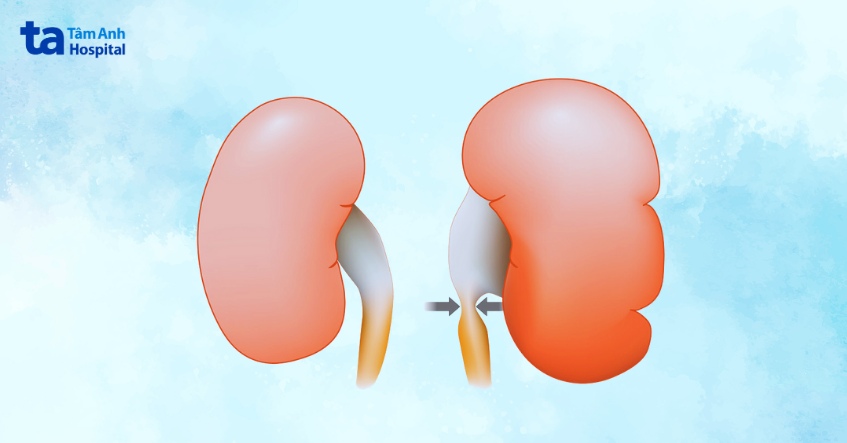 thận ứ nước giai đoạn 3