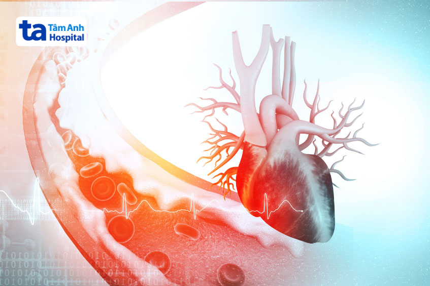 Tình trạng dày lên và xơ cứng làm cản trở lưu lượng máu trong động mạch