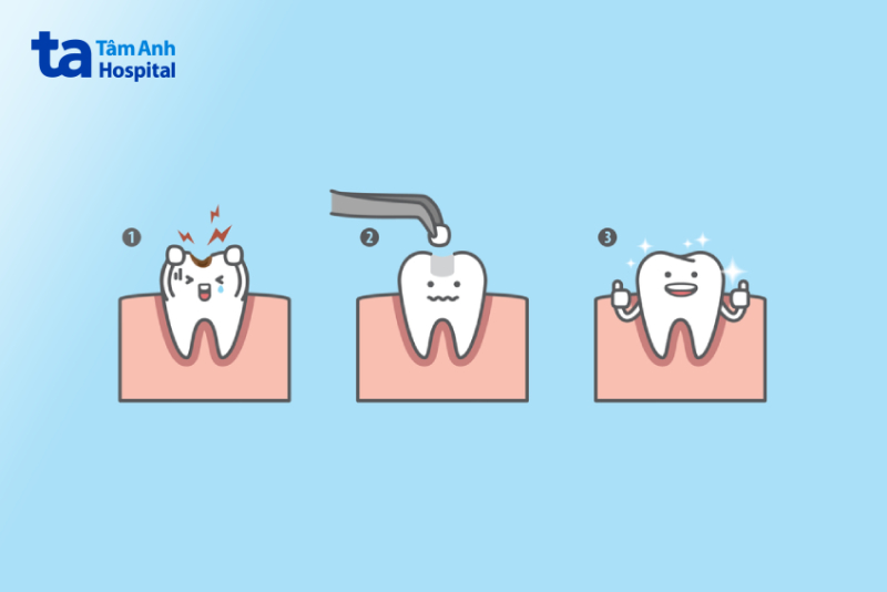 Quy trình trám răng bằng composite diễn ra thế nào?