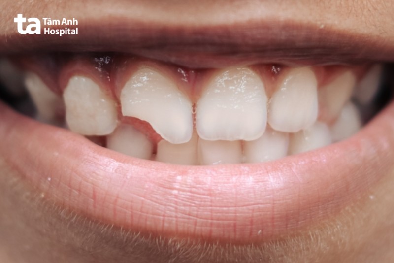 Trường hợp nào có thể hàn răng bằng GIC?