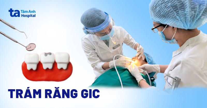 Trám răng GIC là gì? Ưu điểm, nhược điểm và độ bền của vật liệu