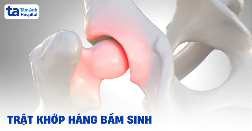Trật khớp háng bẩm sinh: Nguyên nhân, dấu hiệu và cách điều trị