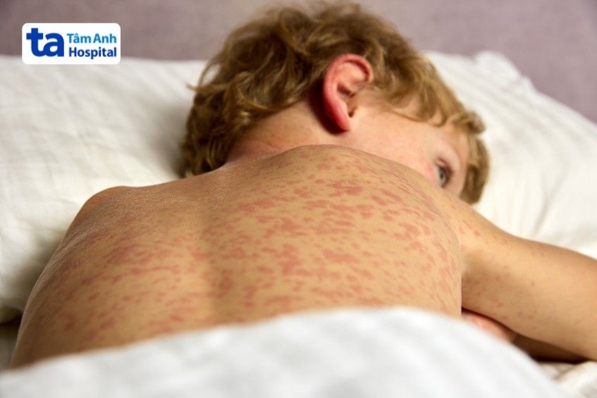 Trẻ bị sởi mệt mỏi, phát ban khắp cơ thể