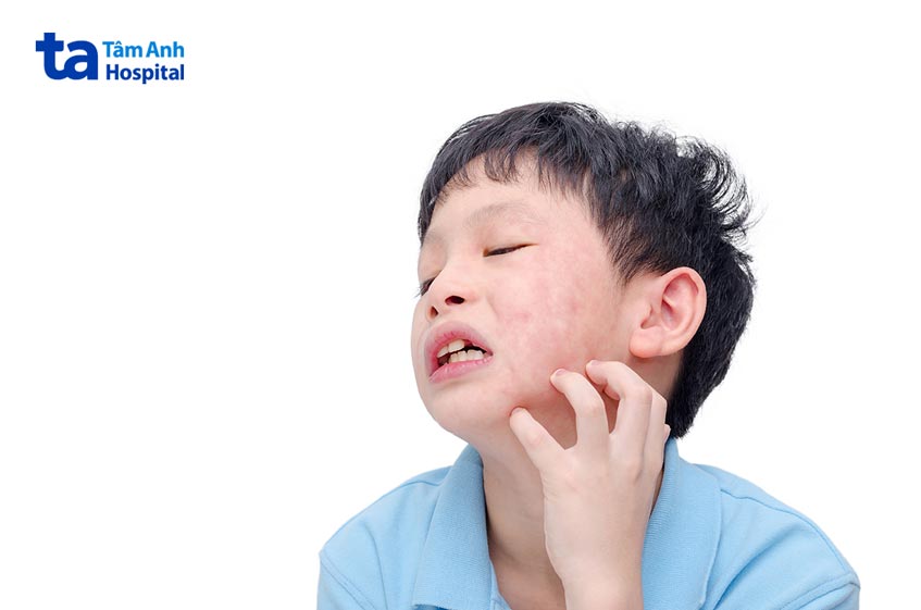 trẻ em thường bị mẩn ngứa do dị ứng nên thận trọng khi uống hapacol 250