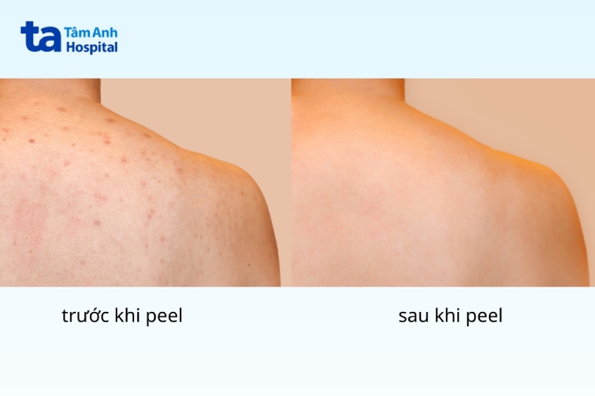 trước và sau khi peel da toàn thân