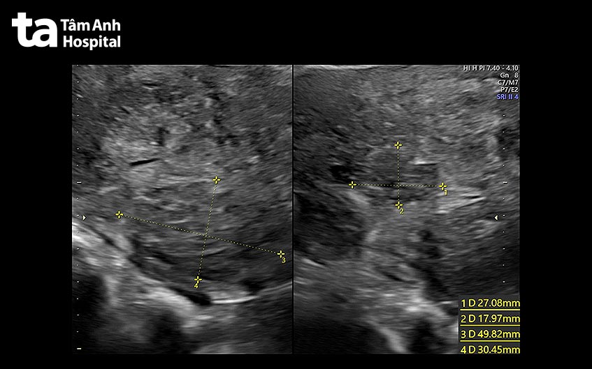 tử cung có nhiều khối u xơ