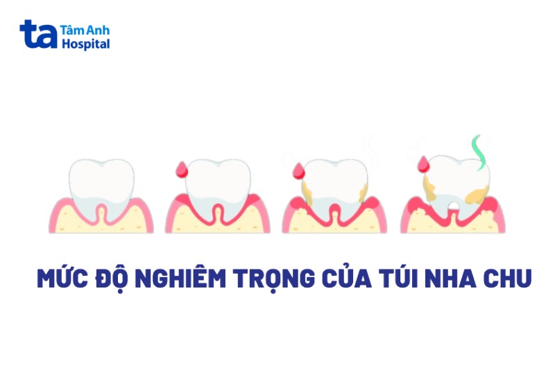 Kích thước và mức độ nghiêm trọng của túi nha chu
