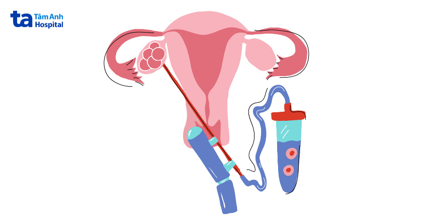 Tùy thuộc vào thể trạng, buồng trứng có thể cần 1 - 2 tuần để phục hồi hoàn toàn sau thủ thuật chọc hút