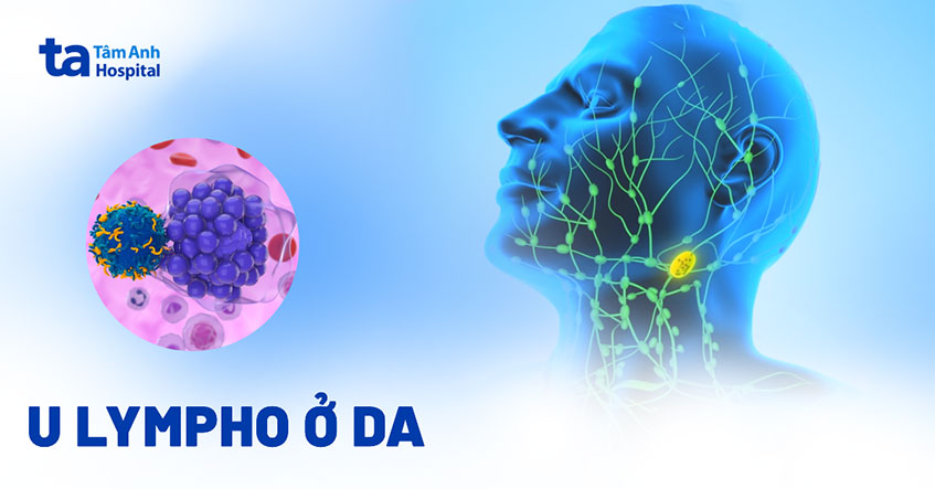 U lympho ở da: Nguyên nhân, dấu hiệu và cách phòng ngừa
