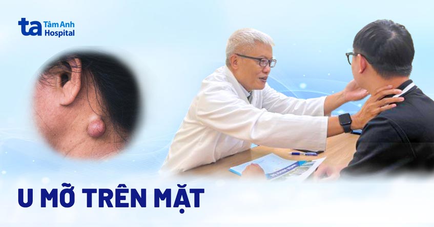 U mỡ trên mặt: Nguyên nhân, dấu hiệu, chẩn đoán, cách điều trị