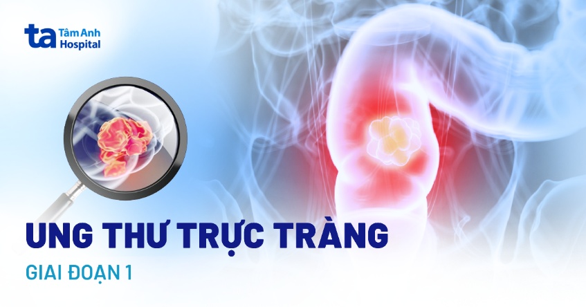 Ung thư trực tràng giai đoạn 1: Dấu hiệu, chẩn đoán và điều trị