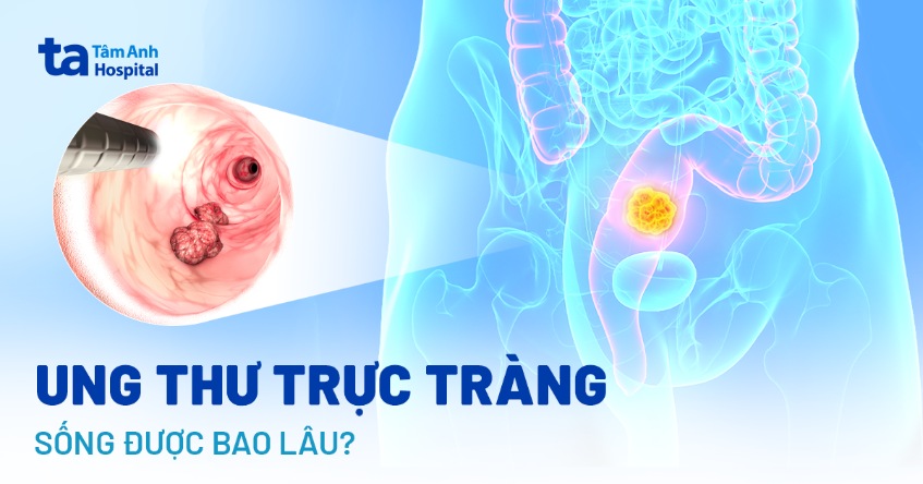 Ung thư trực tràng sống được bao lâu? Tiên lượng từng giai đoạn bệnh