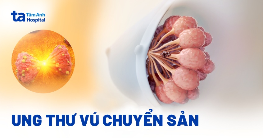 Ung thư vú chuyển sản (MpBC): Nguyên nhân, dấu hiệu và chẩn đoán