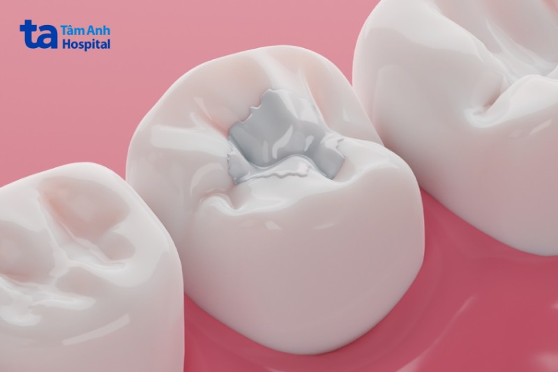 Vật liệu trám răng Composite