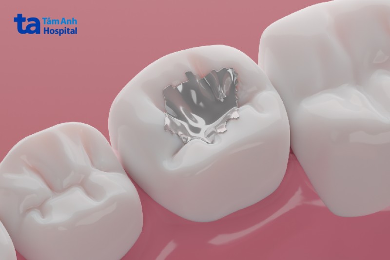 Chất hàn răng Amalgam