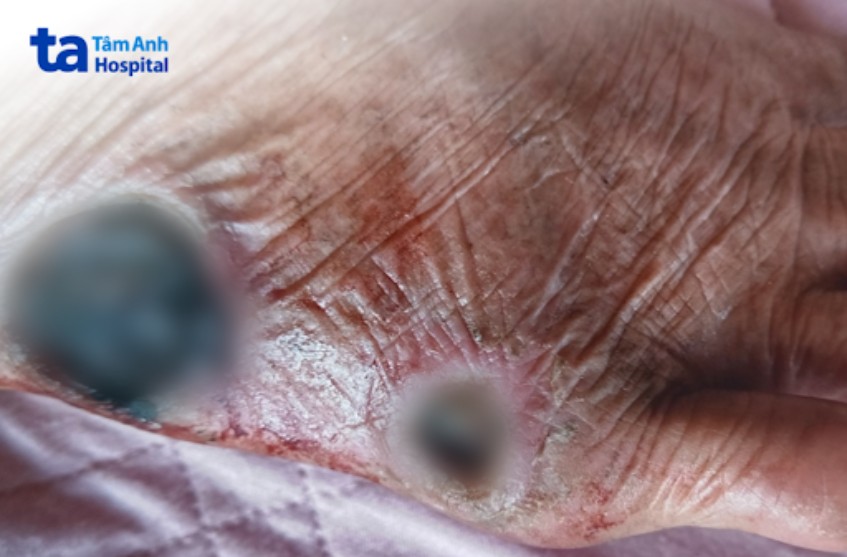 Vết thương ở chân người bệnh tiểu đường bị hoại tử