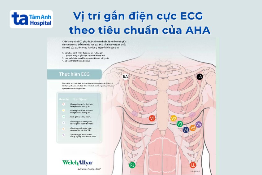 vị trí gắn điện cực ECG
