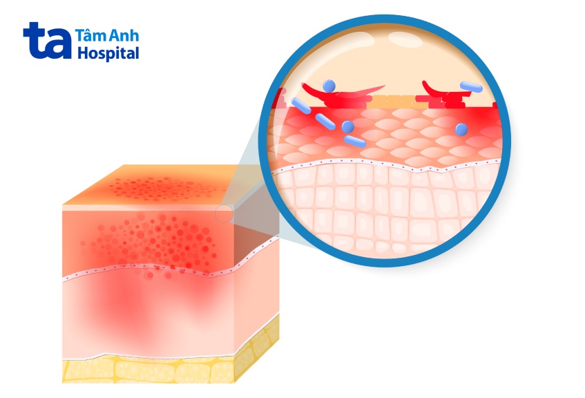 viêm da do kiến ba khoang cắn
