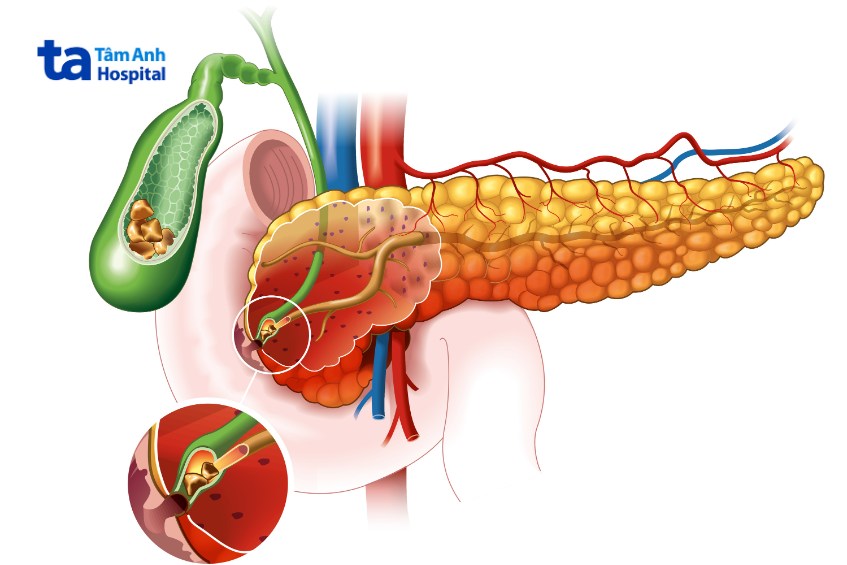 viêm tuyến tụy có nguy hiểm không