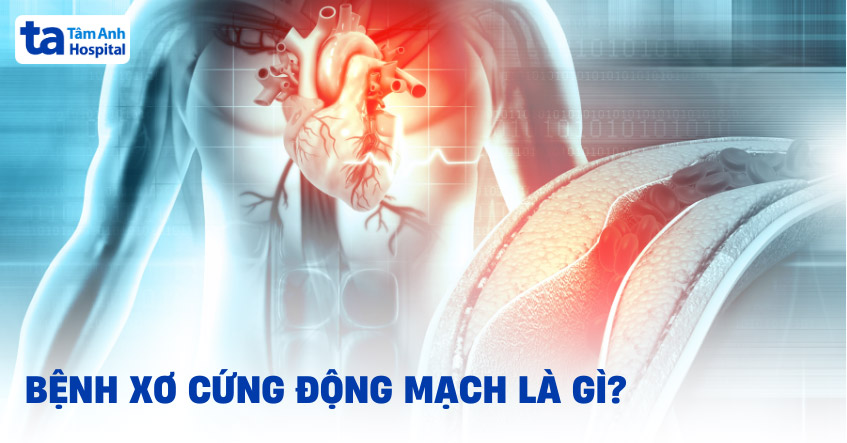Bệnh xơ cứng động mạch: Nguyên nhân, triệu chứng, chẩn đoán, điều trị