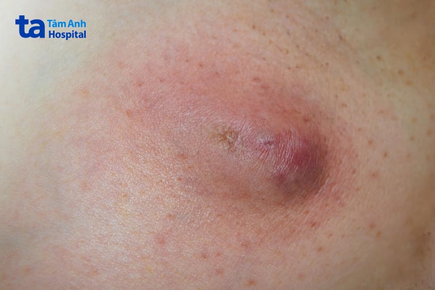 xuất hiện ở dạng nốt sần hoặc khối u