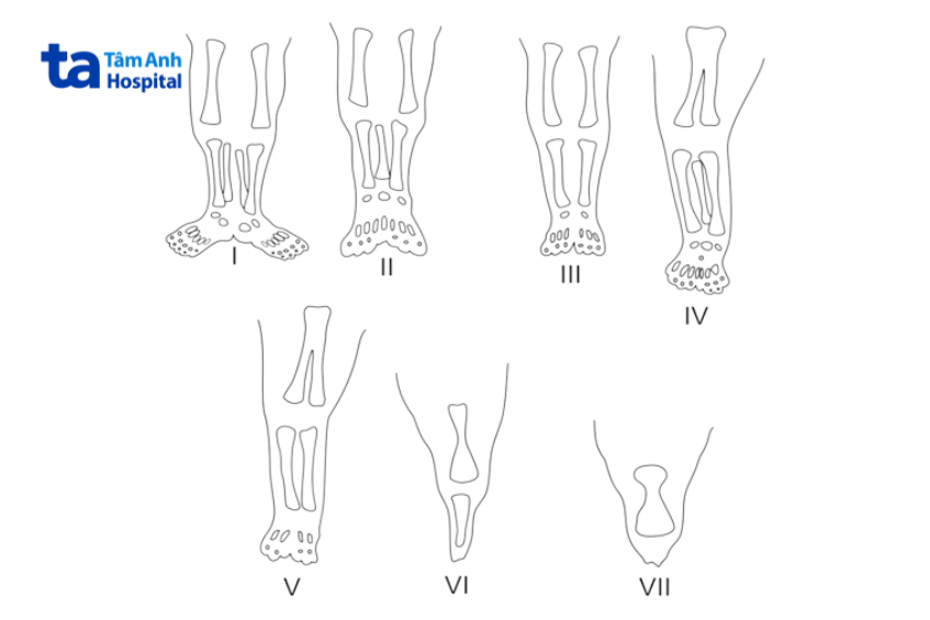 7 loại hội chứng nàng tiên cá